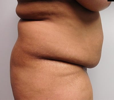 Before Image: Abdominoplasty - other
