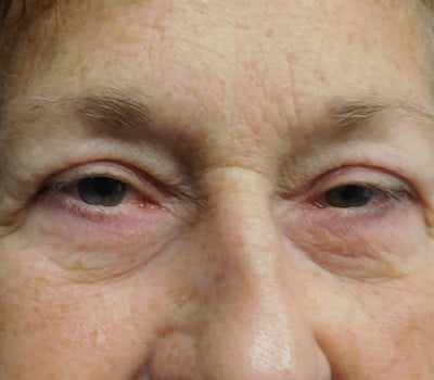 After Image: Blepharoplasty - other