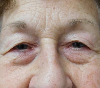 Before Image: Blepharoplasty - other