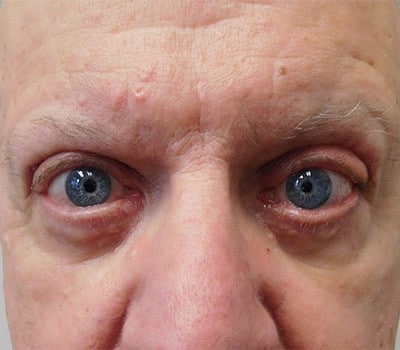 After Image: Blepharoplasty - other