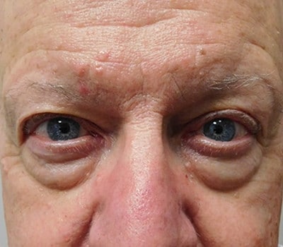 Before Image: Blepharoplasty - other