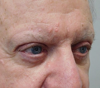 After Image: Blepharoplasty - right-front-oblique