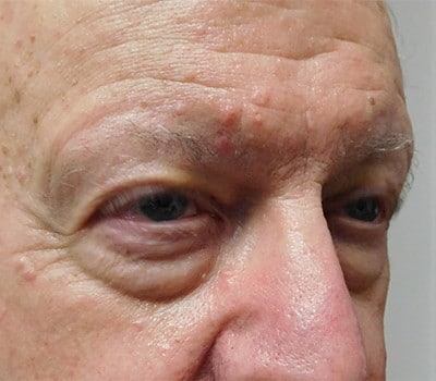 Before Image: Blepharoplasty - right-front-oblique