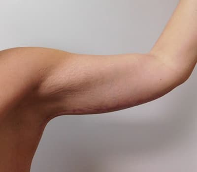 After Image: Brachioplasty - right-side