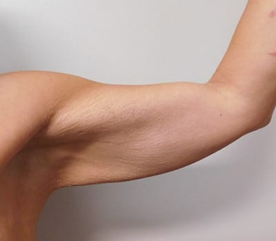 Before Image: Brachioplasty - right-side