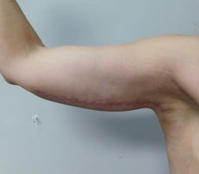 After Image: Brachioplasty - left-side