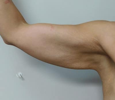 Before Image: Brachioplasty - left-side