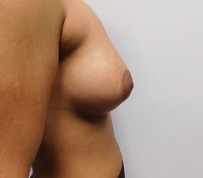 After Image: Breast Augmentation - right-side