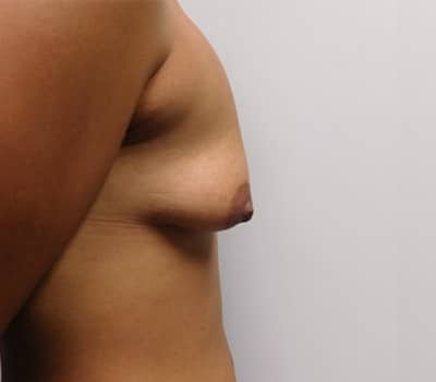 Before Image: Breast Augmentation - right-side