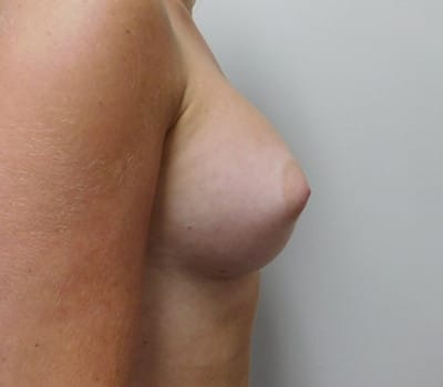 After Image: Breast Augmentation - right-side