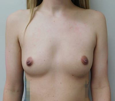 Before Image: Breast Augmentation - front