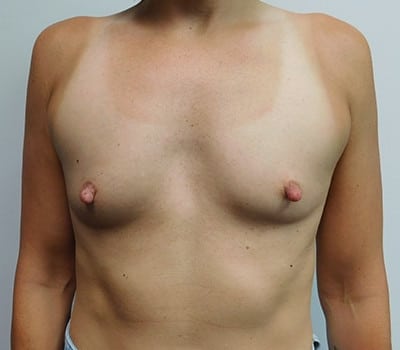 Before Image: Breast Augmentation - front