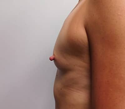 Before Image: Breast Augmentation - left-side