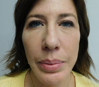 After Image: Face Lift - front