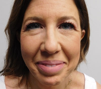 Before Image: Face Lift - front
