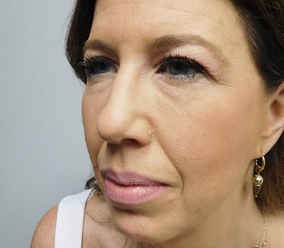 Before Image: Face Lift - left-front-oblique