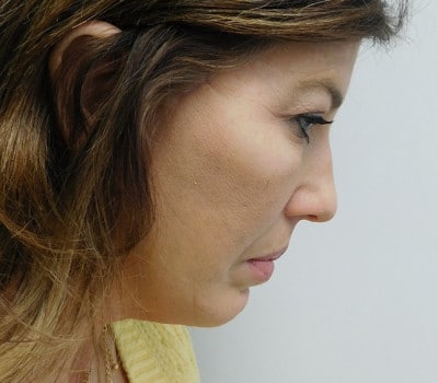 After Image: Face Lift - right-side