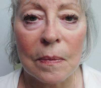 After Image: Face Lift - front