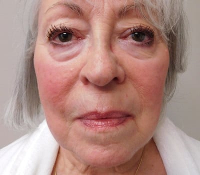 Before Image: Face Lift - front