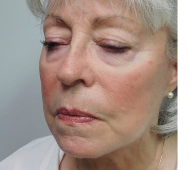 After Image: Face Lift - left-front-oblique