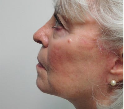 After Image: Face Lift - left-side