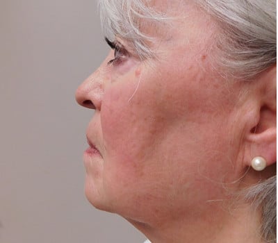 Before Image: Face Lift - left-side