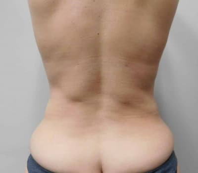 After Image: Liposuction - front