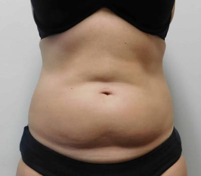 Before Image: Liposuction - front