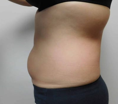 Before Image: Liposuction - left-side