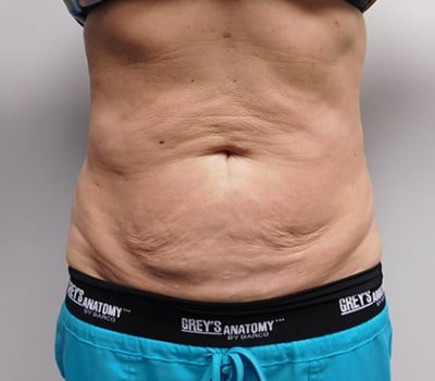 After Image: Liposuction - front