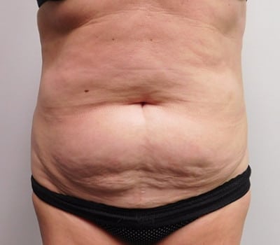 Before Image: Liposuction - front