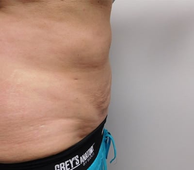After Image: Liposuction - right-side