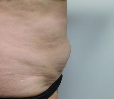 Before Image: Liposuction - right-side