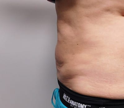 After Image: Liposuction - left-side