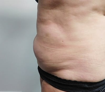 Before Image: Liposuction - left-side