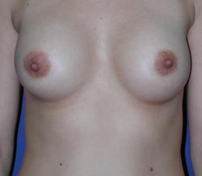 After Image: Saline Implant Subpectoral Bilateral - front