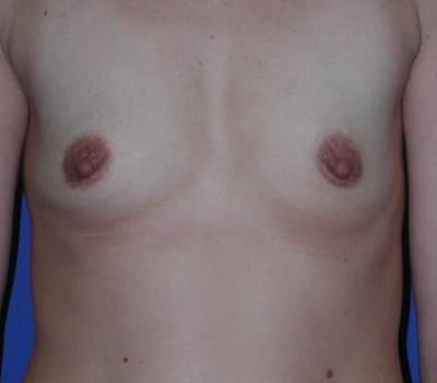 Before Image: Saline Implant Subpectoral Bilateral - front