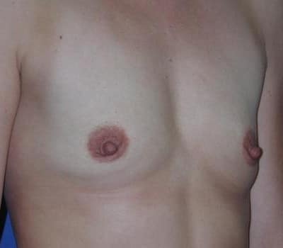 Before Image: Saline Implant Subpectoral Bilateral - right-front-oblique