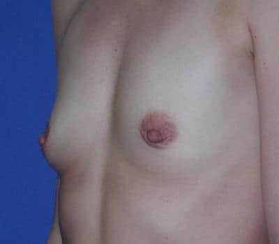 Before Image: Saline Implant Subpectoral Bilateral - left-front-oblique