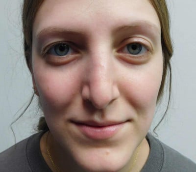 After Image: Rhinoplasty - front