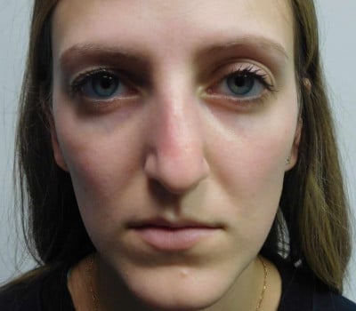 Before Image: Rhinoplasty - front