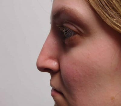 After Image: Rhinoplasty - other