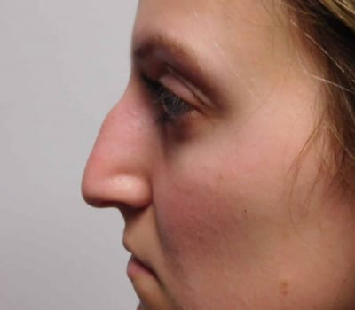 Before Image: Rhinoplasty - other
