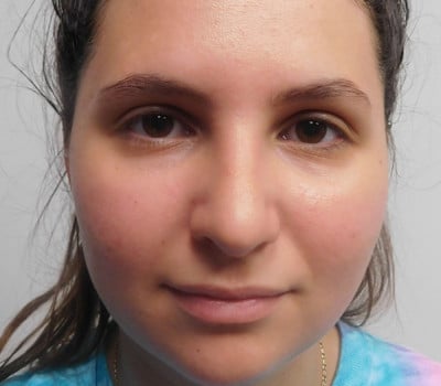 After Image: Rhinoplasty - front
