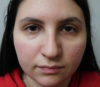 Before Image: Rhinoplasty - front