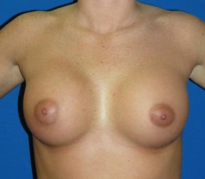 After Image: Saline Implants - front