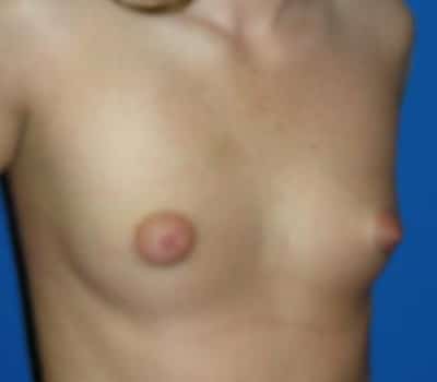 Before Image: Saline Implants - other