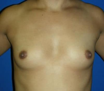 Before Image: Saline Implant Augmentation - front