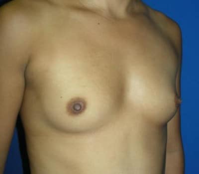 Before Image: Saline Implant Augmentation - other