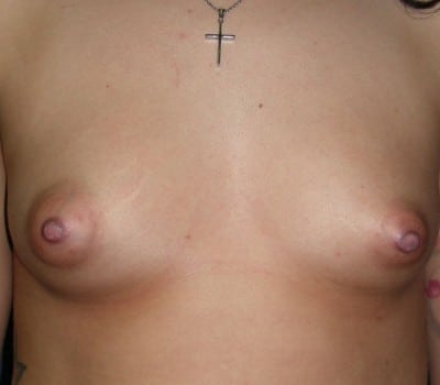 Before Image: Saline Implants - front